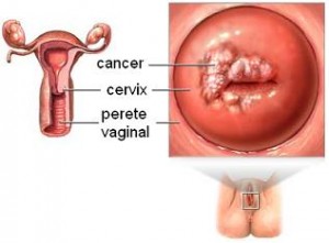 cancer cervical